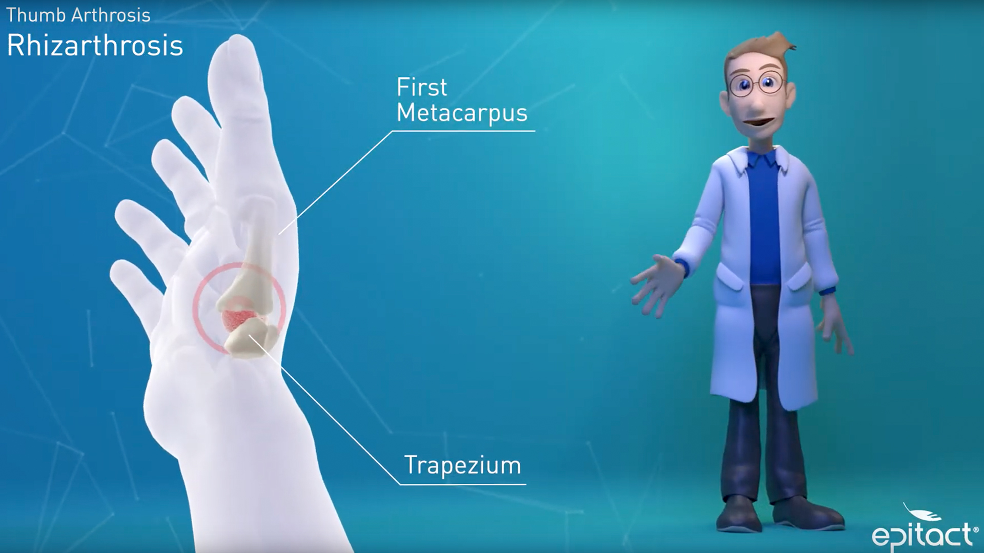 arthrose main epitact