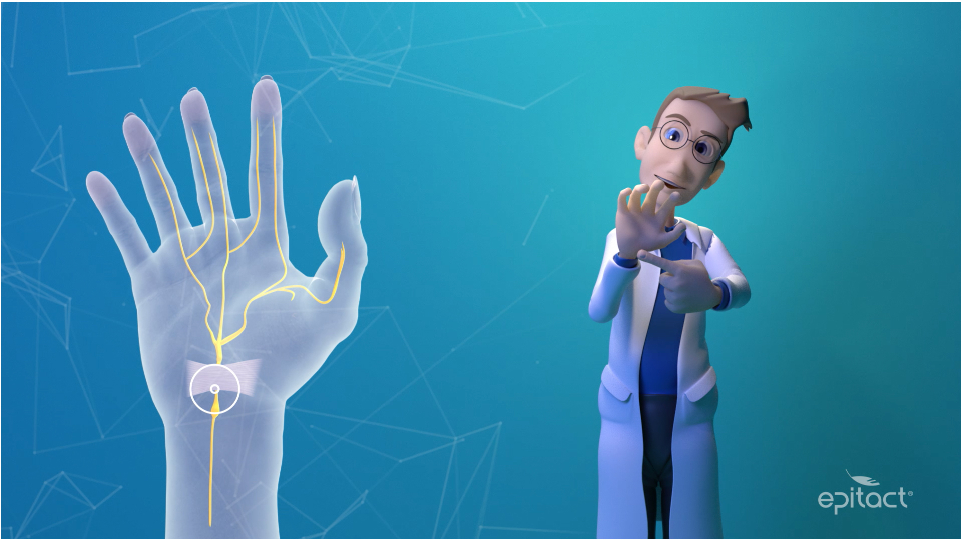 syndrome du canal carpien epitact