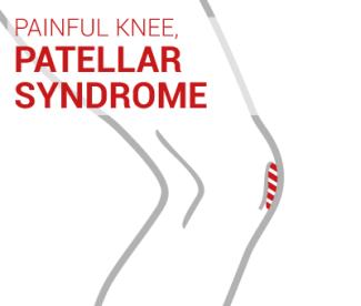 Patellar syndrome