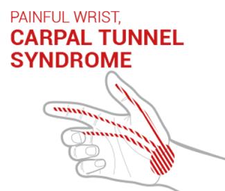 carpal tunnel syndrome