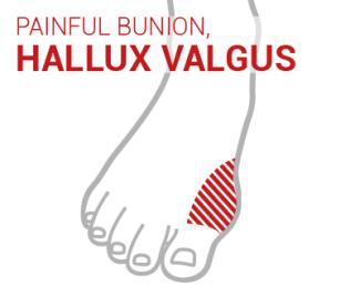bunions