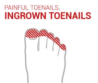 ingrown toenails